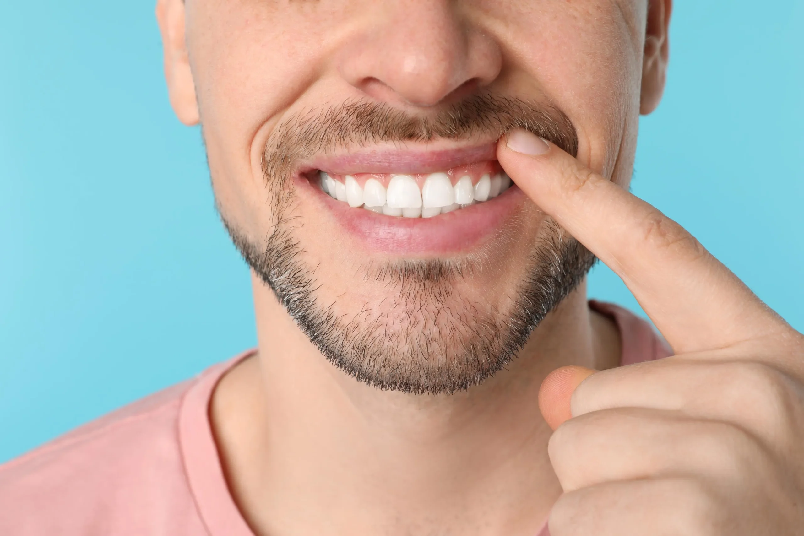 Sorriso con faccette dentali