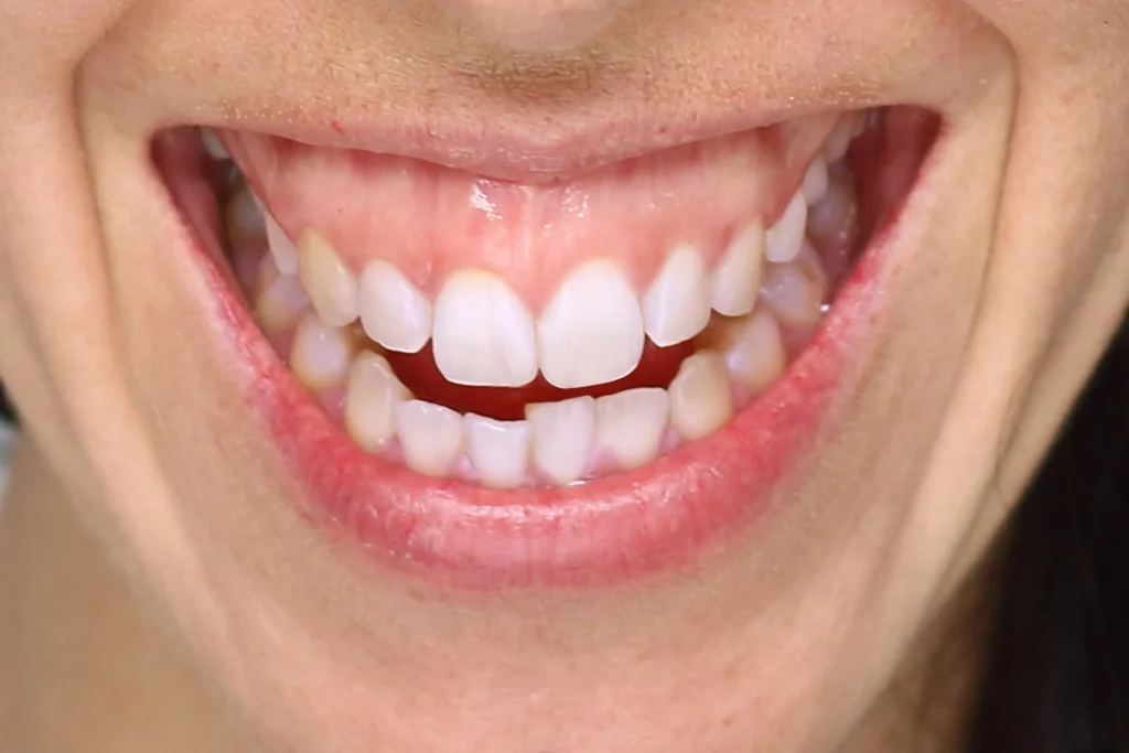 Sorriso gengivale, detto anche gummy smile