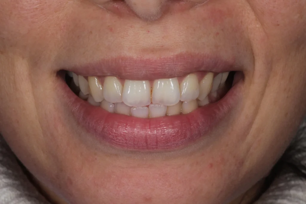 Prima dello sbiancamento dentale