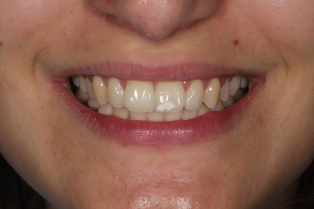 Prima dello sbiancamento dentale