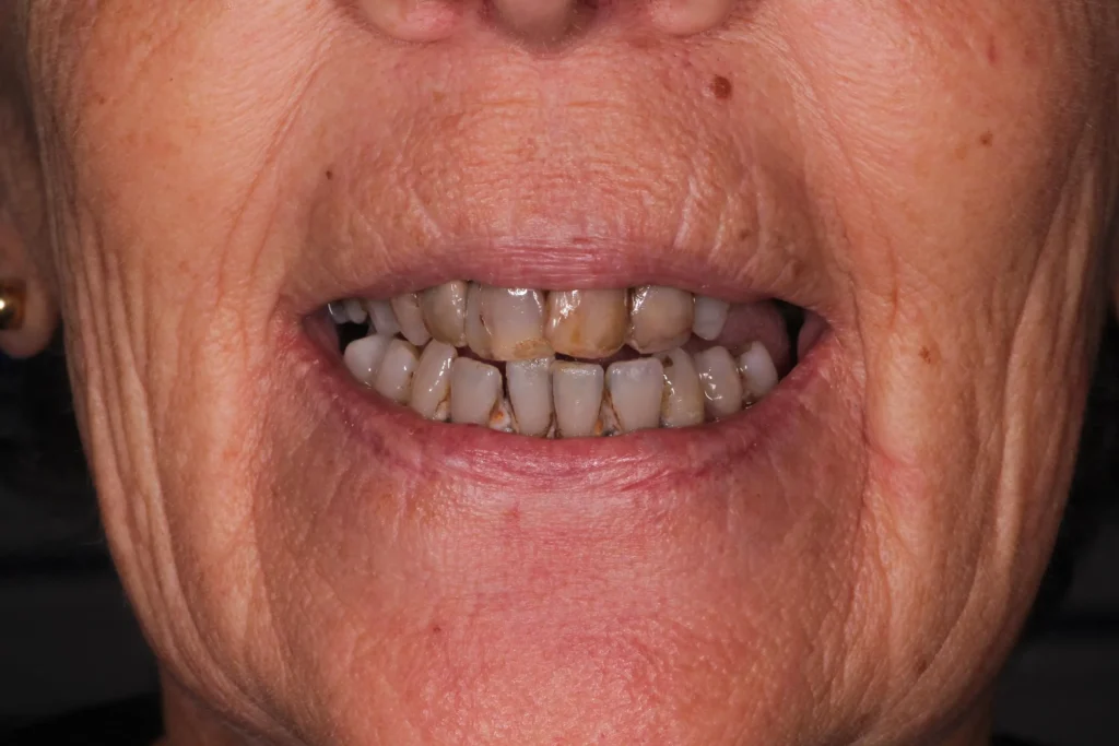 Prima di un makeover di estetica dentale