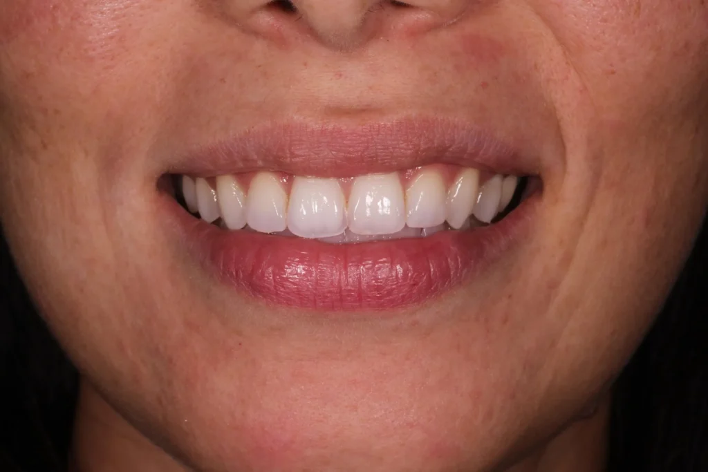 Dopo il trattamento di sbiancamento dentale