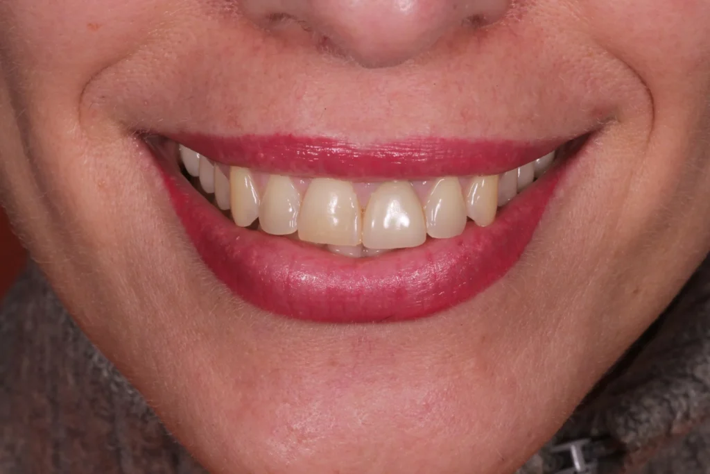 Prima dello sbiancamento dentale 