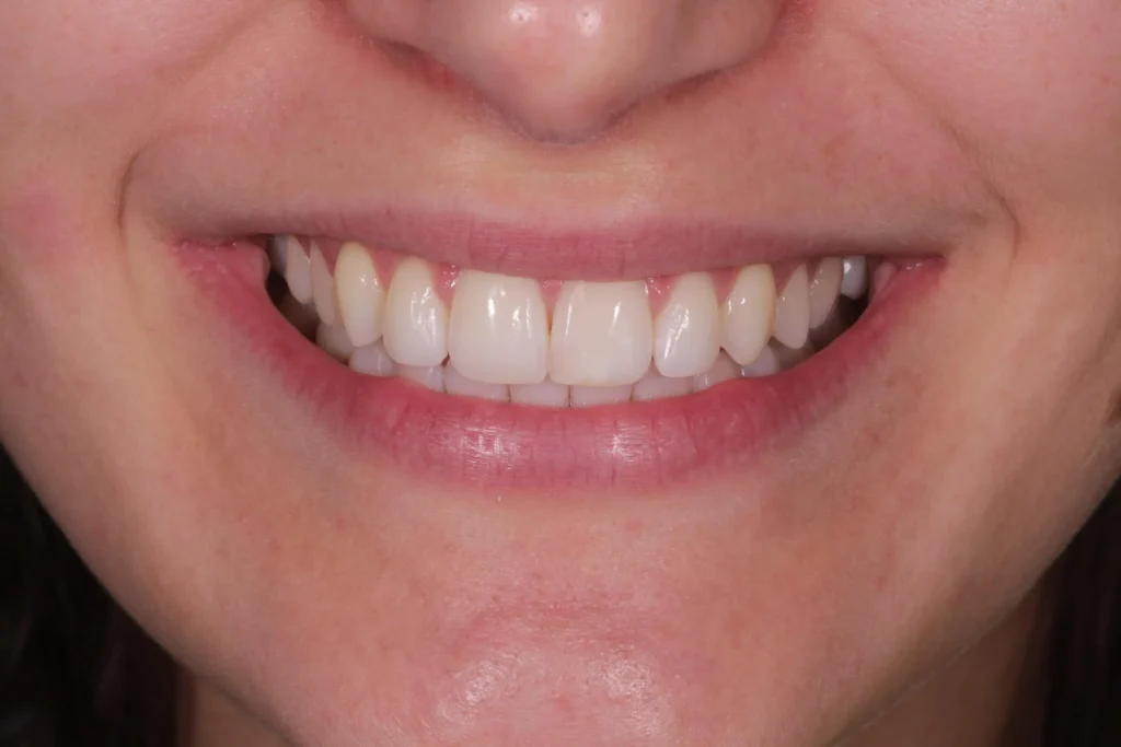 Dopo il trattamento di sbiancamento dentale