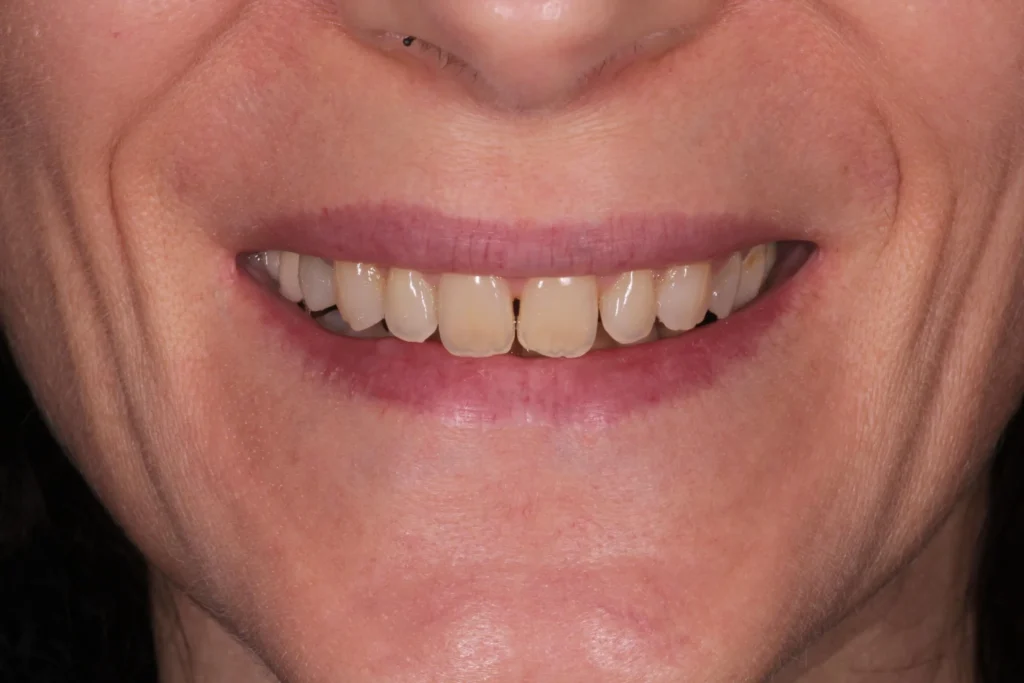Prima dello sbiancamento dentale