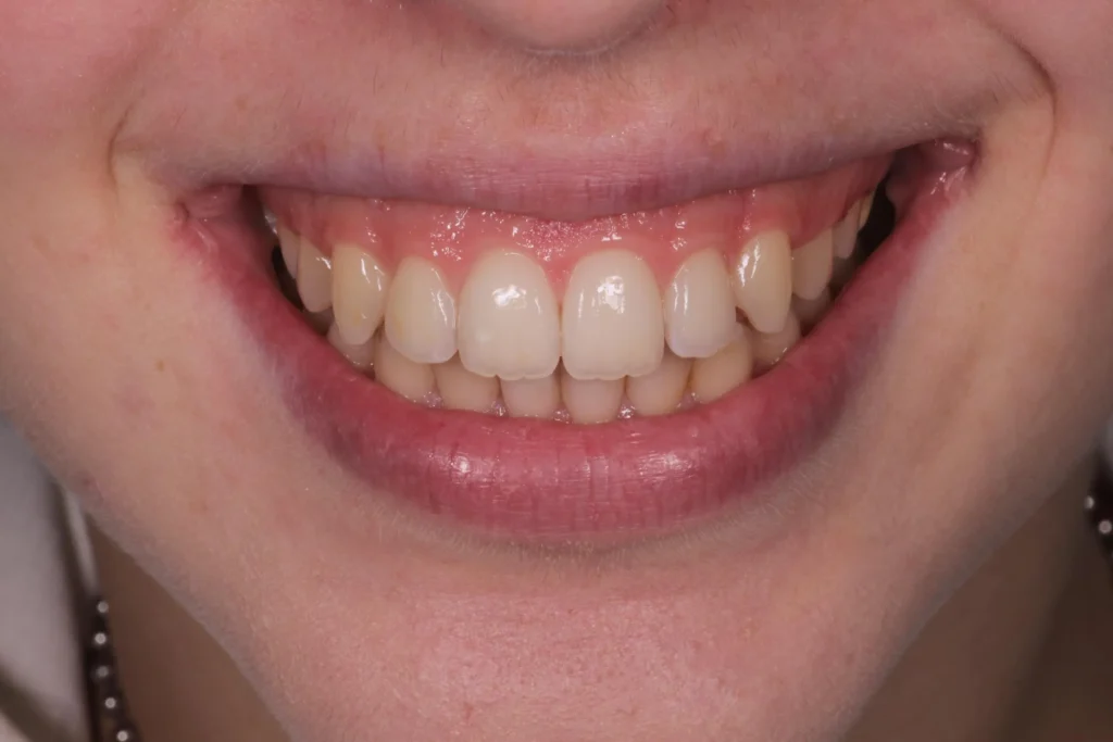 Prima del trattamento di sbiancamento domiciliare attraverso mascherine personalizzate fornite dal dentista. 
