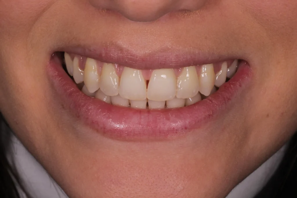 Prima dello sbiancamento dentale