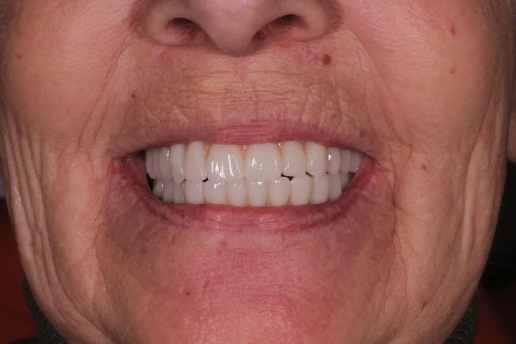 Dopo il makeover di estetica dentale 