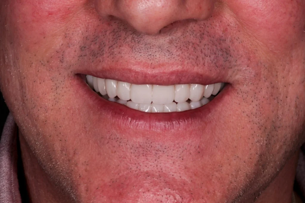 Dopo l'applicazione di faccette dentali 