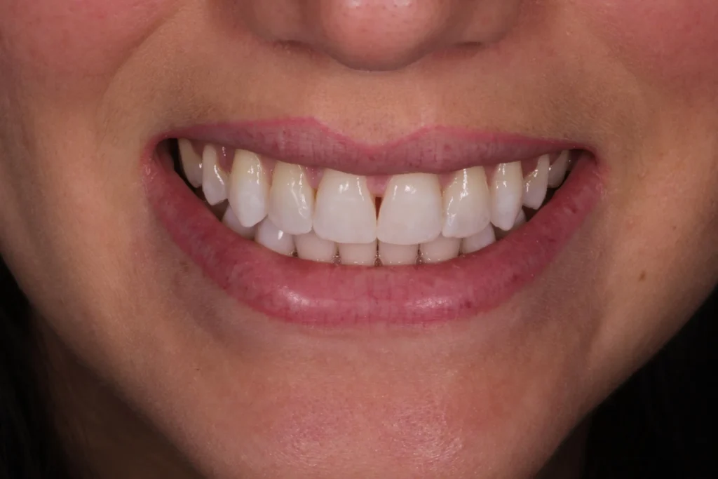 Dopo il trattamento di sbiancamento dentale