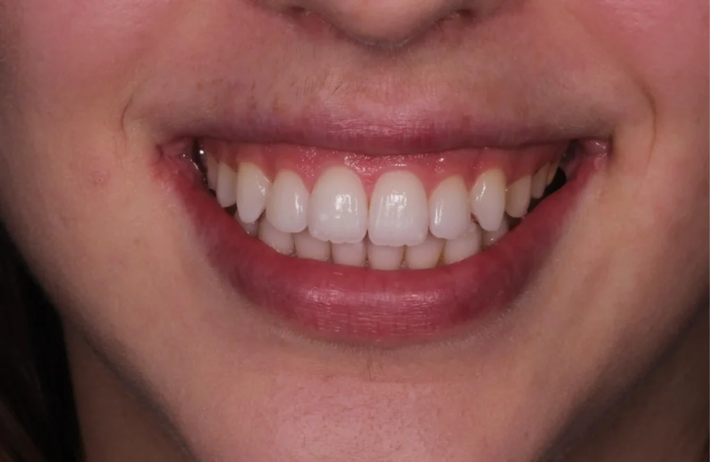 Dopo del trattamento di sbiancamento domiciliare attraverso mascherine personalizzate fornite dal dentista. 