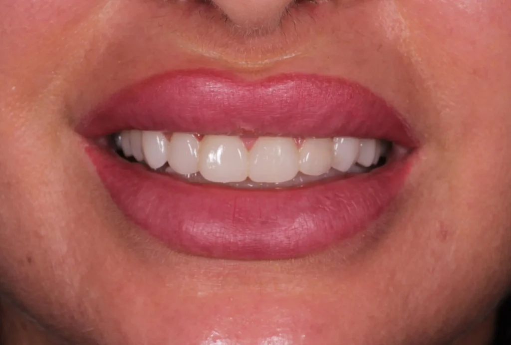 Dopo di trattamenti di estetica dentale. 