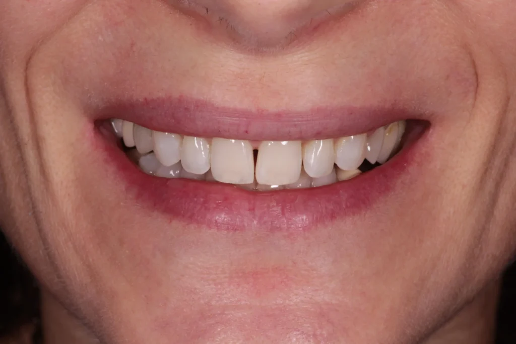Dopo il trattamento di sbiancamento dentale