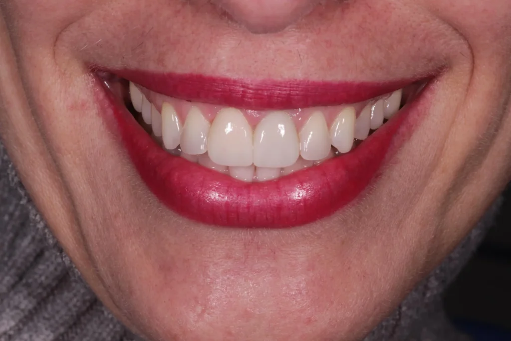 Dopo lo sbiancamento dentale 