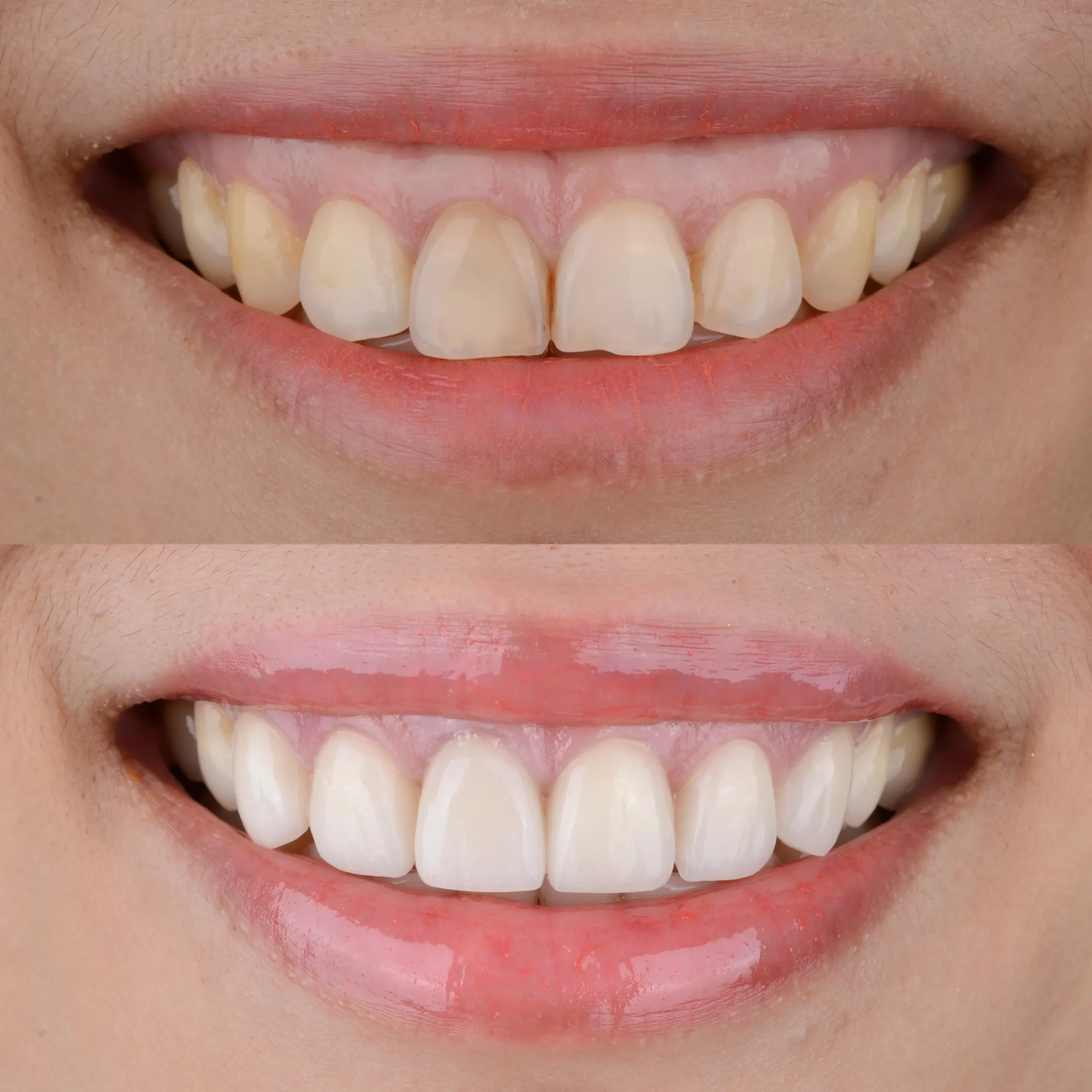 SORRISO GENGIVALE PRIMA E DOPO LA CURA DEL GUMMY SMILE