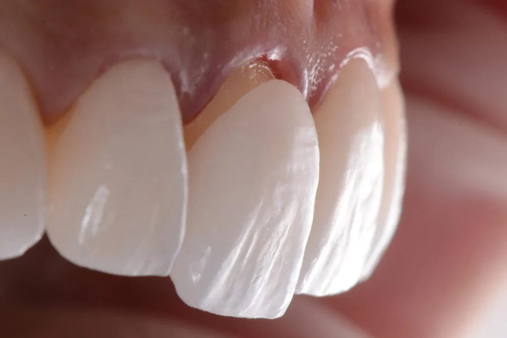 Faccette dentali