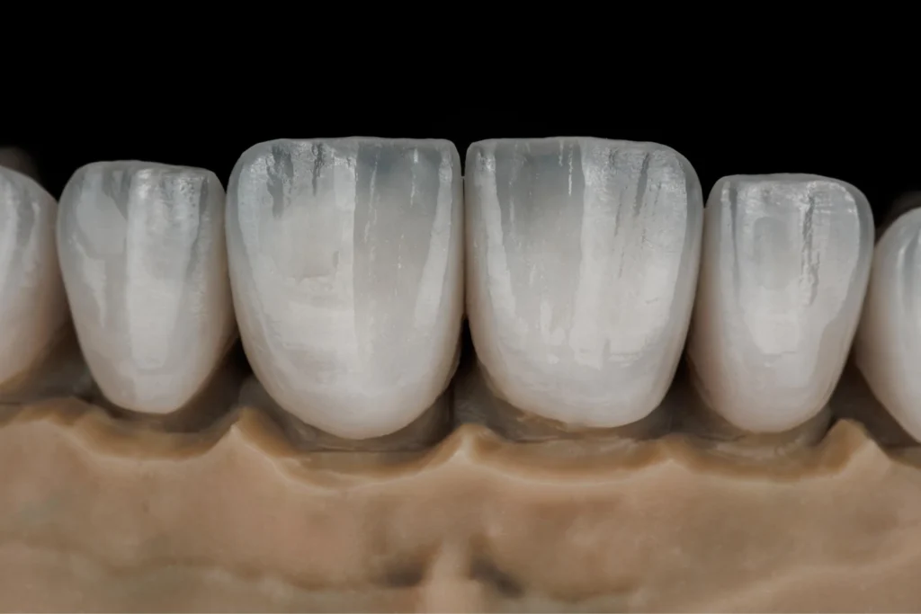 Faccette dentali in ceramica 