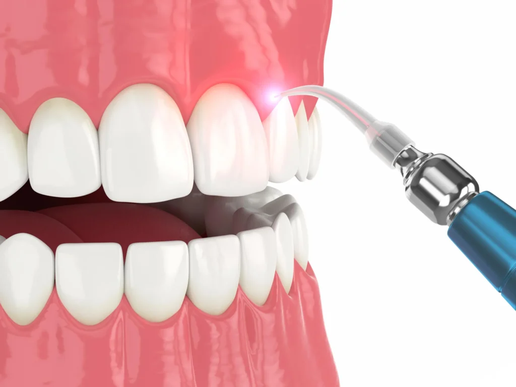 Gengivectomia con laser