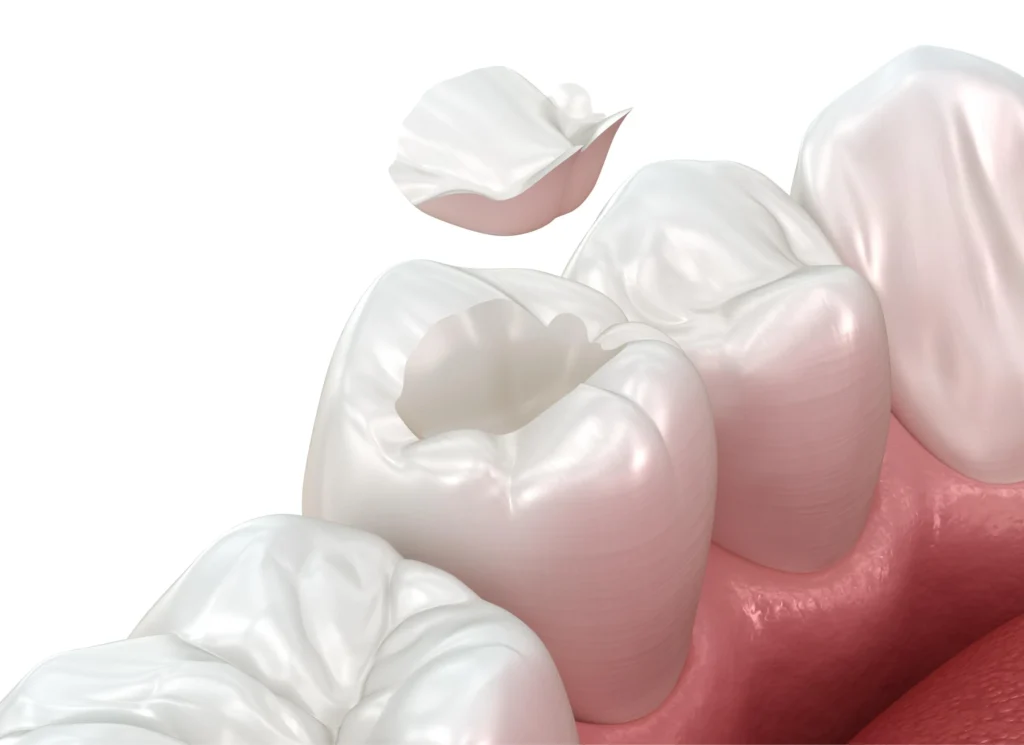 intarsio dentale