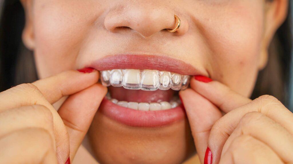 Mascherine trasparenti Invisalign