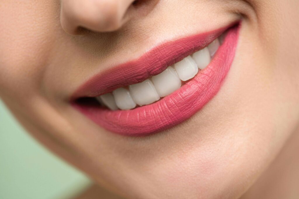 sorriso post intarsio dentale