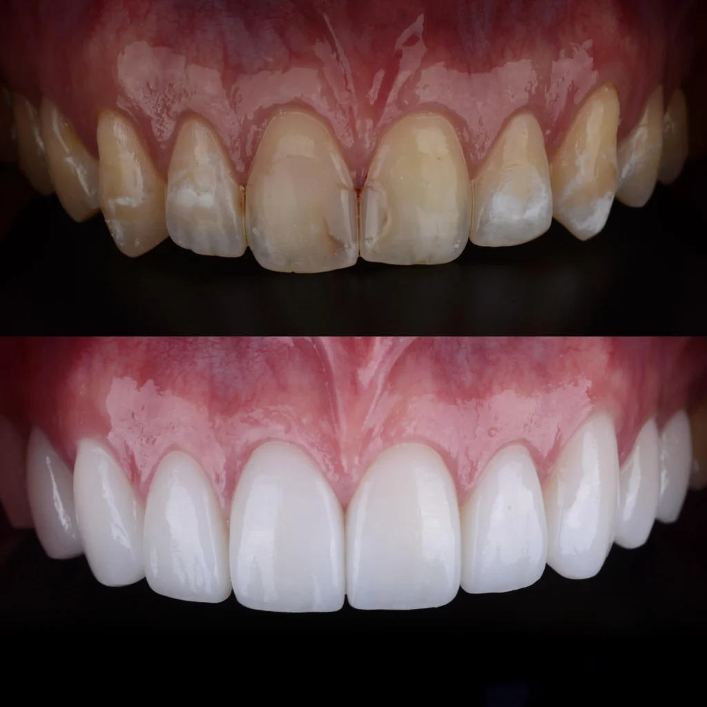 Esempio del primo e dopo trattamenti di ricostruzione estetica del sorriso. 