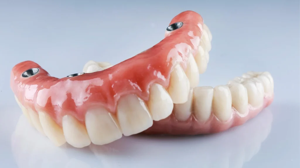 Denti su impianti 