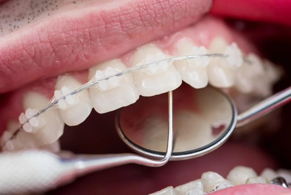 Apparecchio tradizionale con brackets