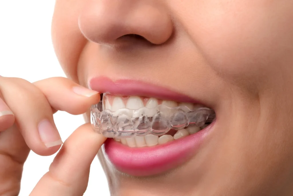 Ortodonzia invisibile Invisalign
