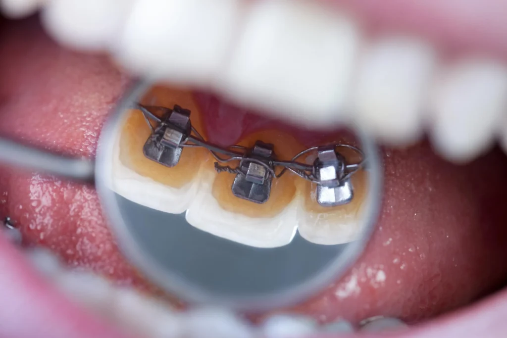 Apparecchio linguale, che si applica sul retro dei denti.
