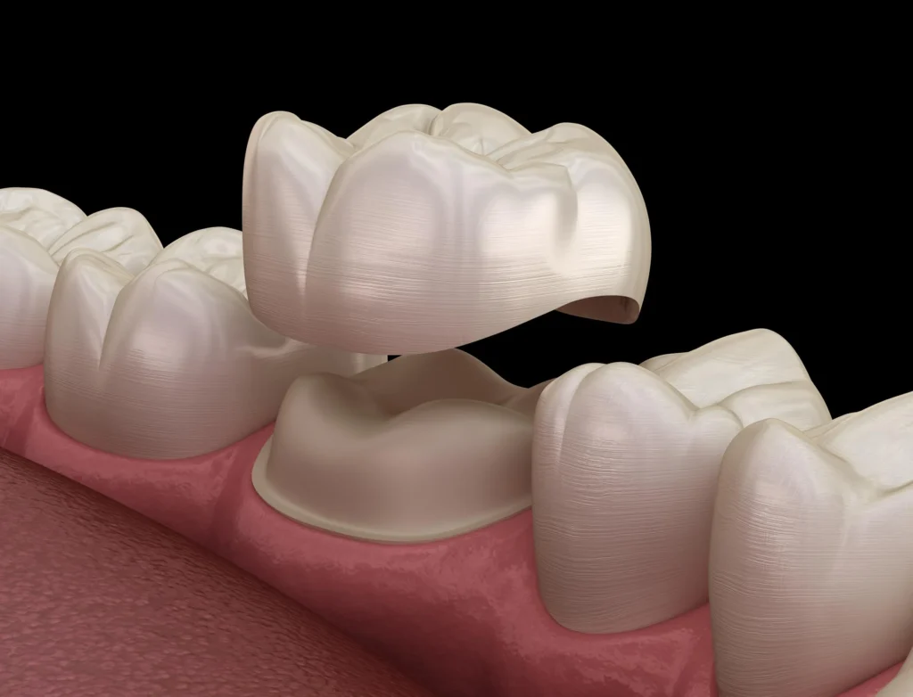 Esempio applicazione corona in ceramica