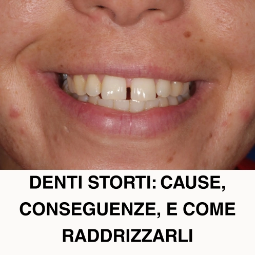 denti storti cause conseguenze e come raddrizzarli denti storti cause conseguenze e come raddrizzarli