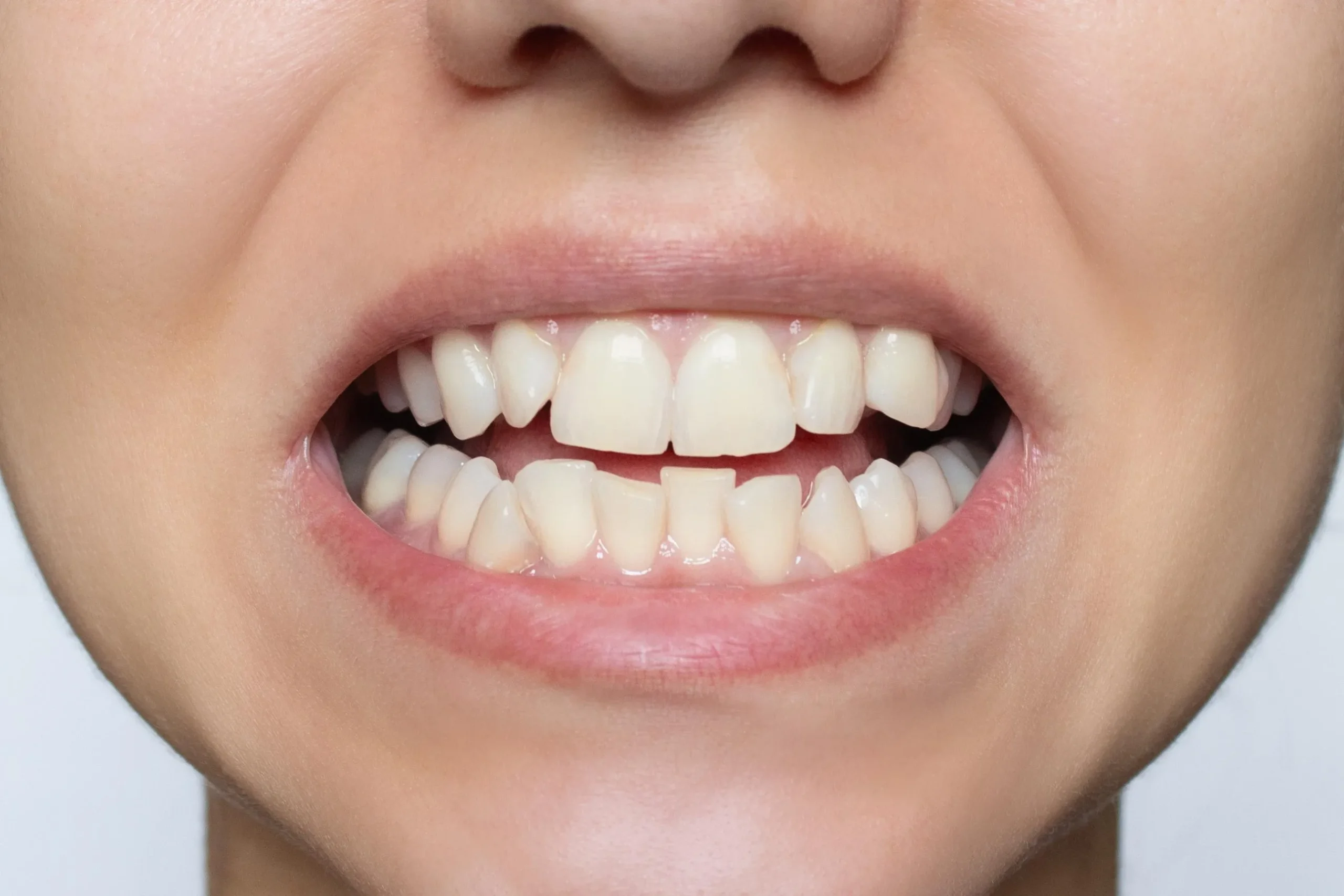 malocclusione dentale e denti storti