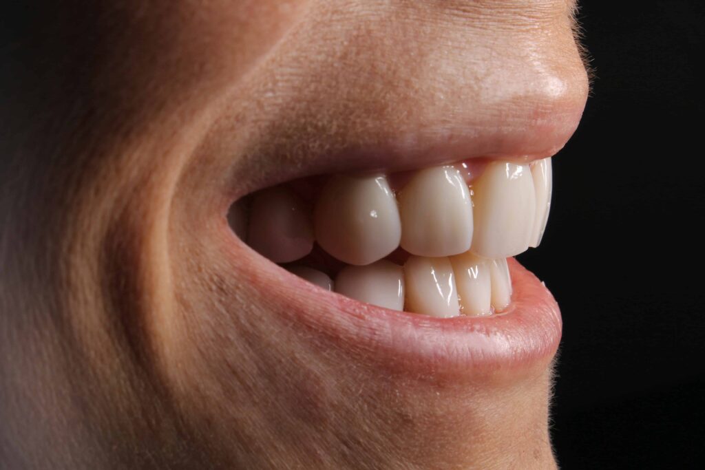 Esempio di occlusione dentale, ovvero la modalità in cui i denti si incontrano quando si chiude la bocca.