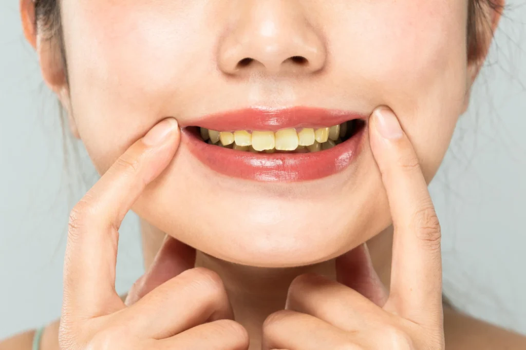 Denti gialli
