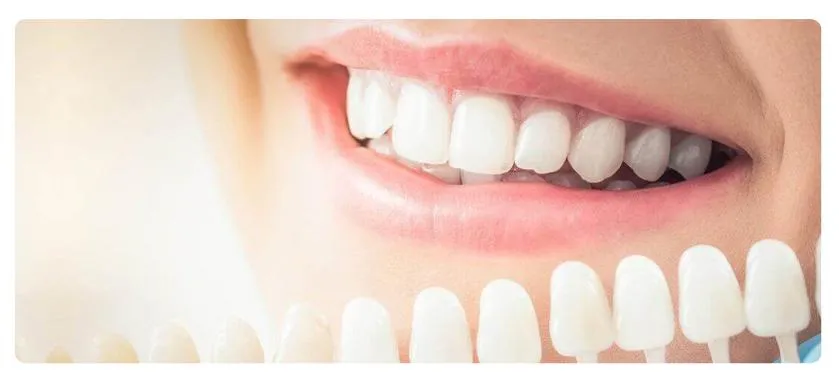 Corone in ceramica e sbiancamento dentale