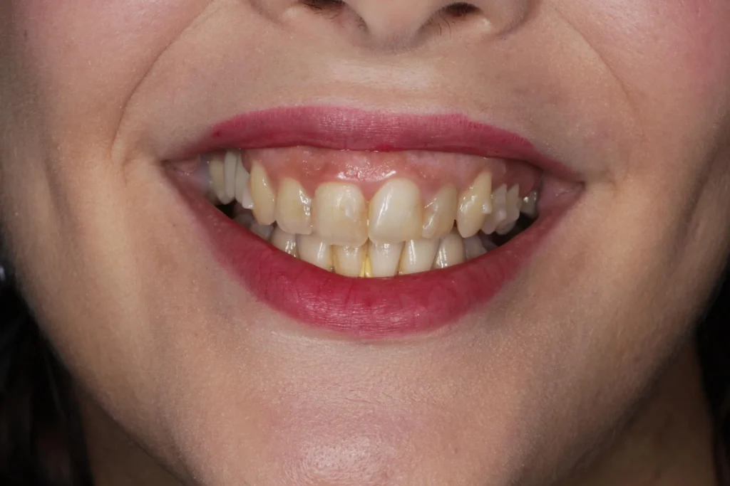 Sorriso gengivale prima del trattamento Faccette dentali + invisalign