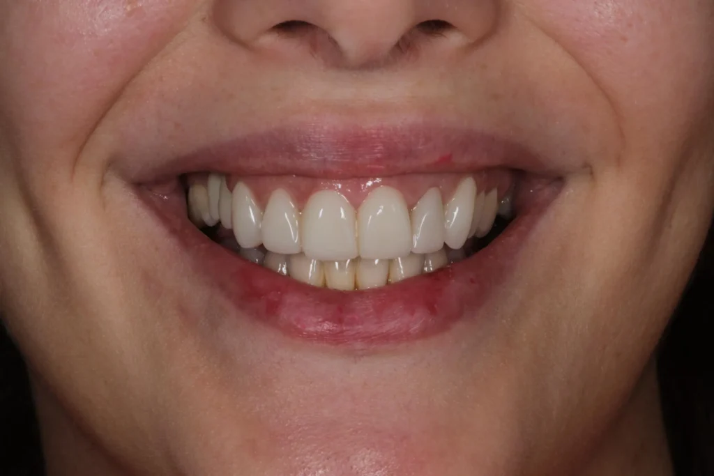 Sorriso dopo il trattamento di faccette dentali + invisalign con cura del gummy smile