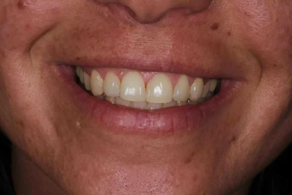 Sorriso con denti dritti dopo il trattamento