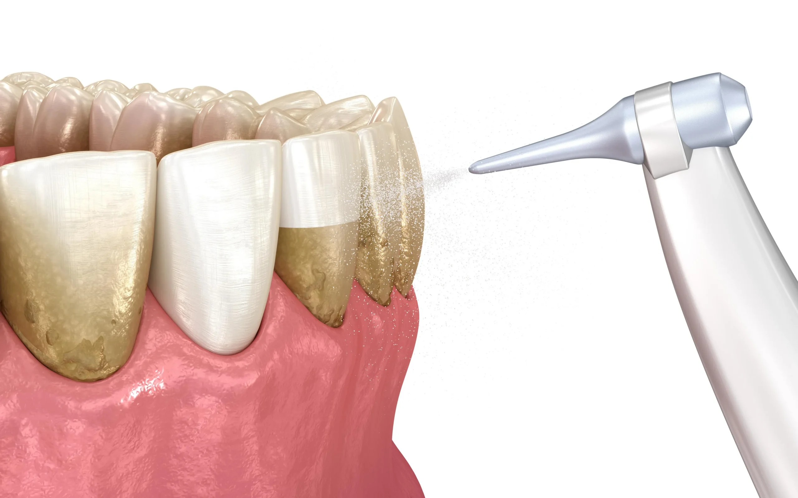 Pulizia dei denti innovativa con la tecnica GBT