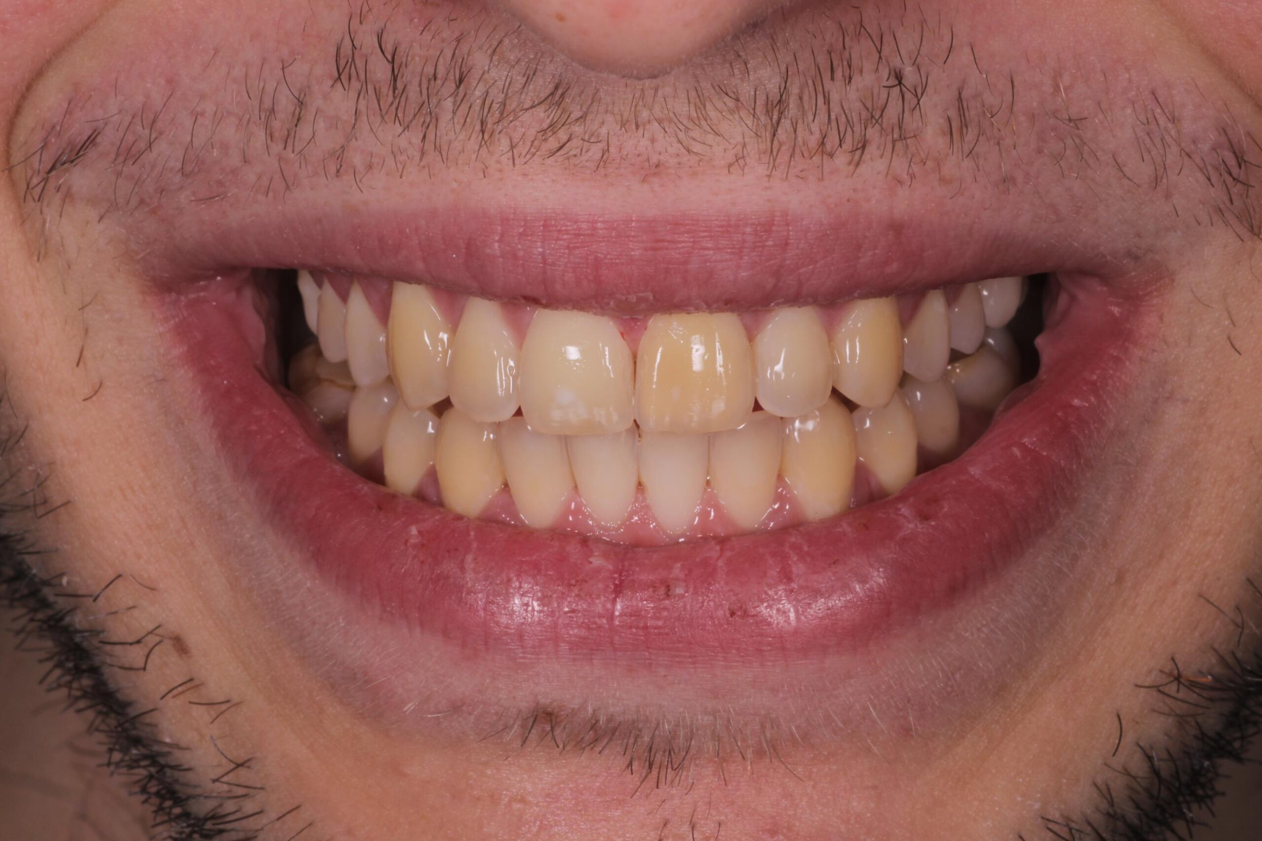 Denti con evidente accumulo di tartaro.