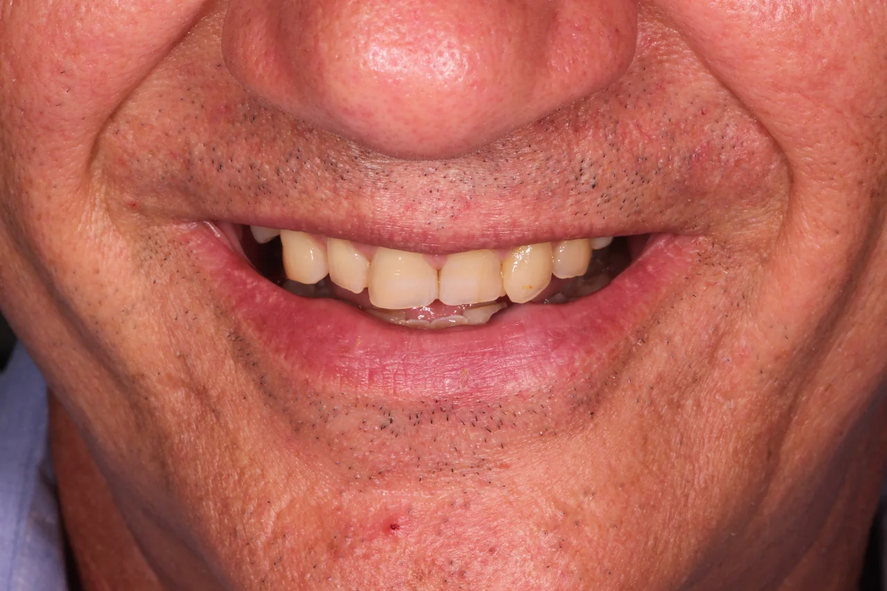 caso di sorriso uomo prima del percorso di estetica dentale sorriso iconico