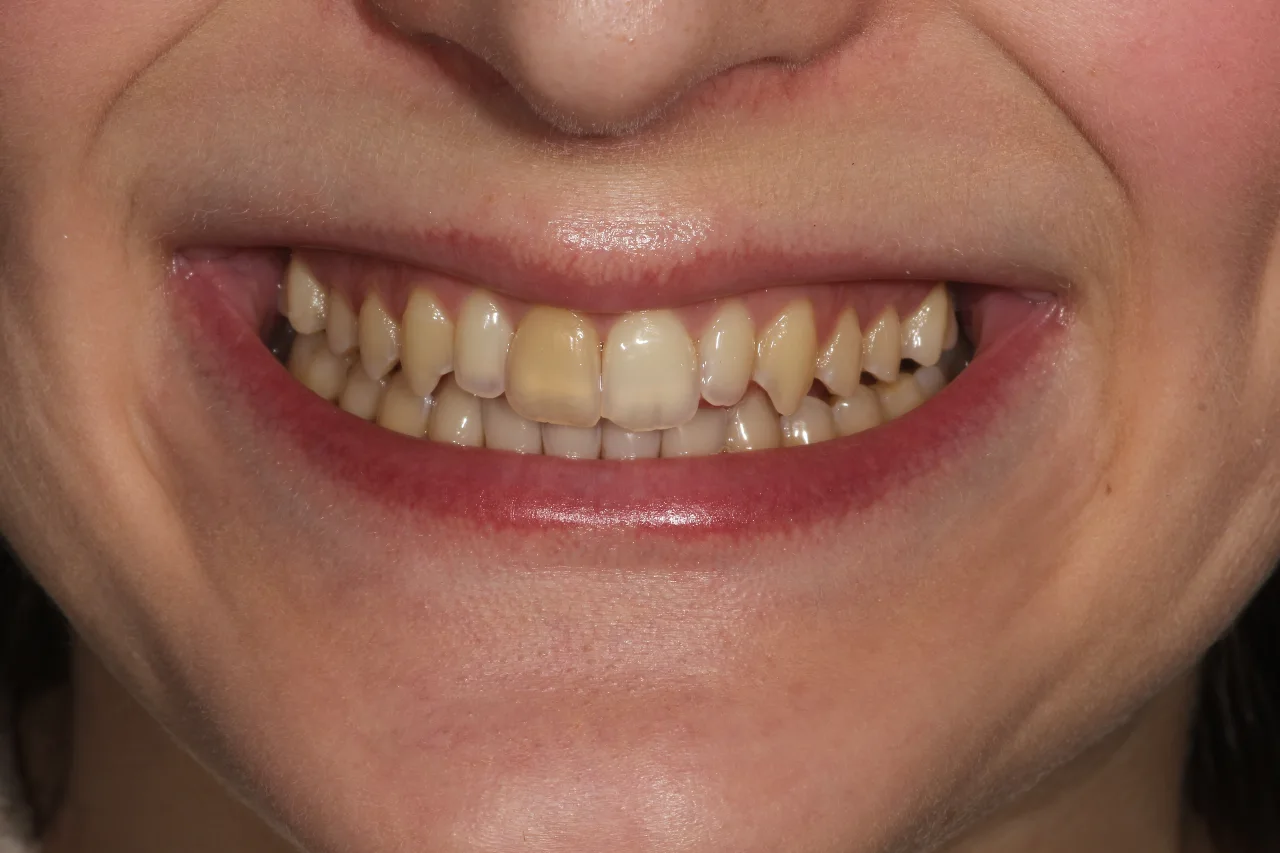 sorriso tonico sbiancamento + bonding dentale caso margherita prima