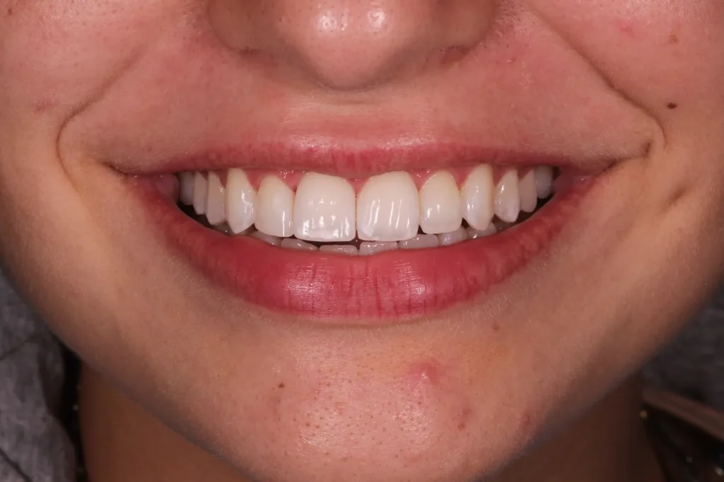 bonding dentale dopo il trattamento