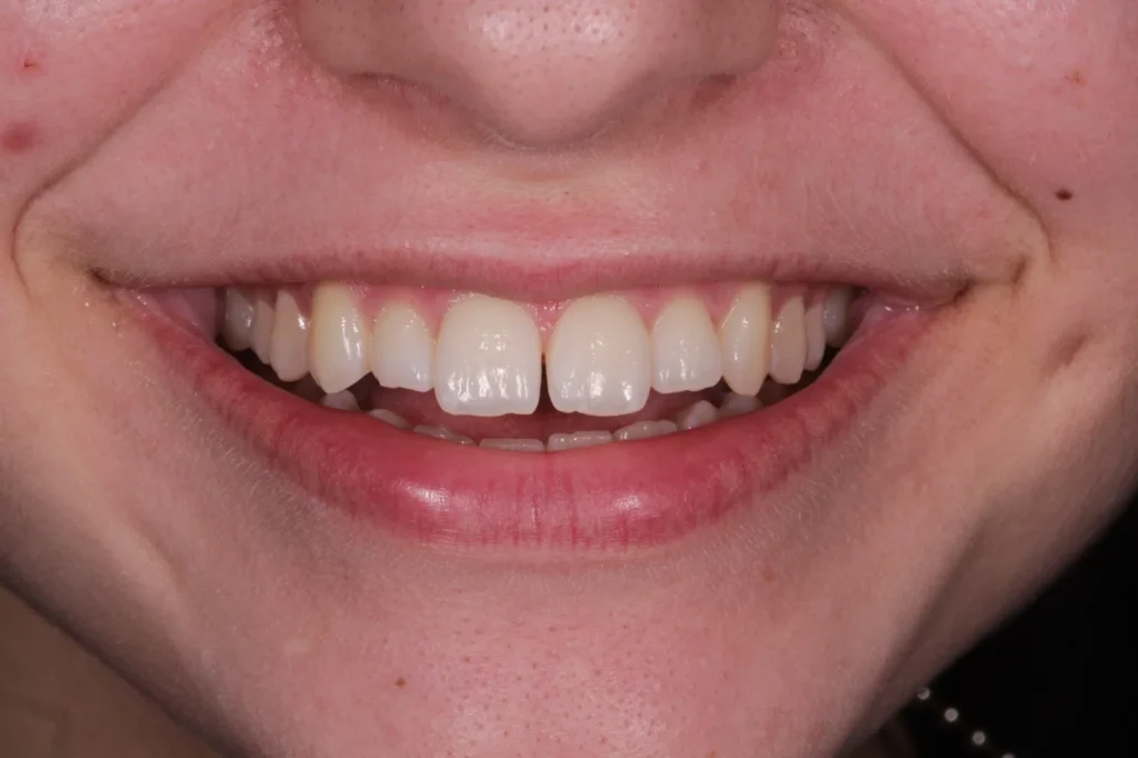 bonding dentale prima del trattamento