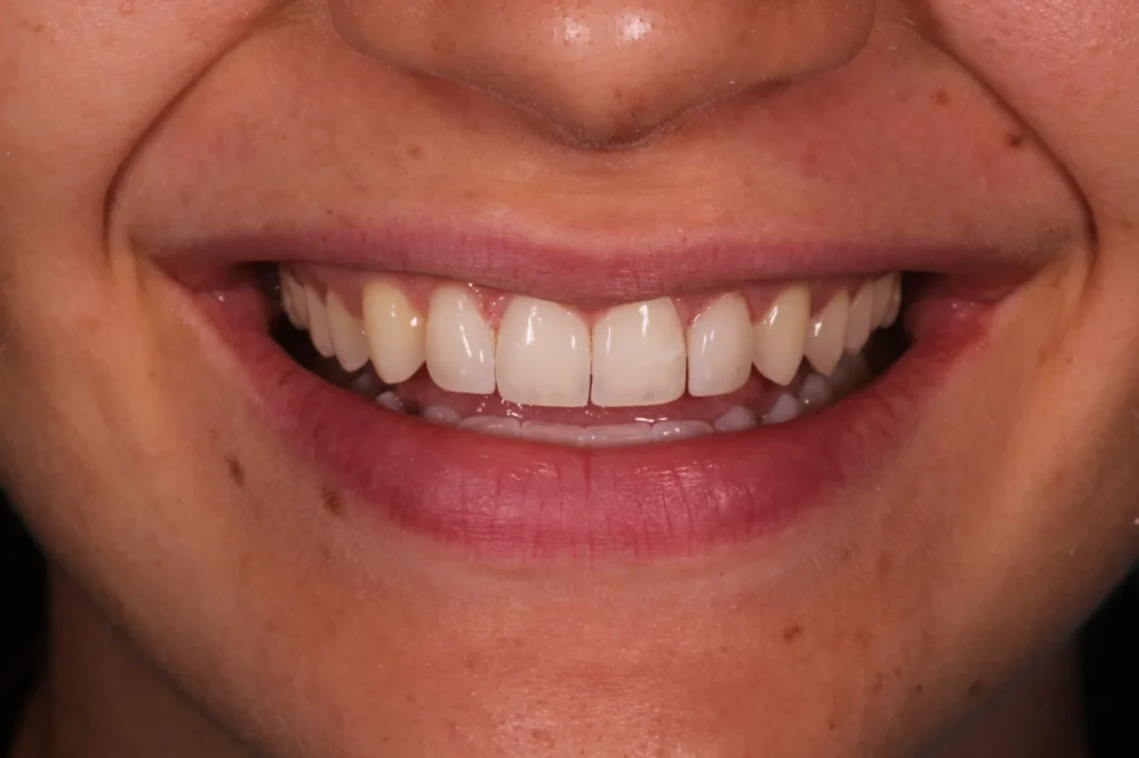 trattamento di contouring dentale o bonding dentale dopo