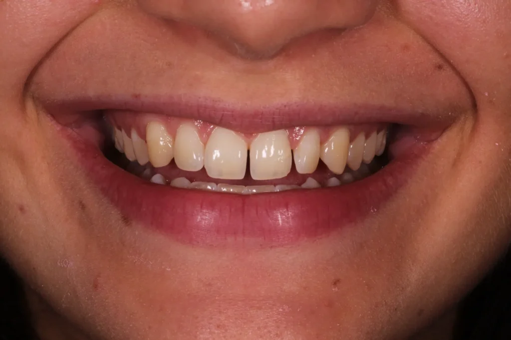 trattamento di contouring dentale o bonding dentale prima