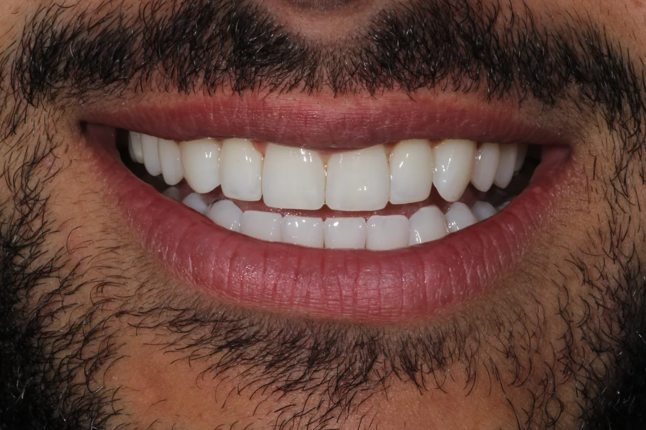 caso di bonding dentale 19 marzo dopo