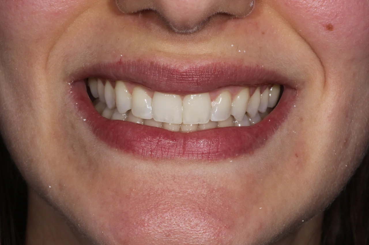 caso di bonding dentale 21 marzo dopo