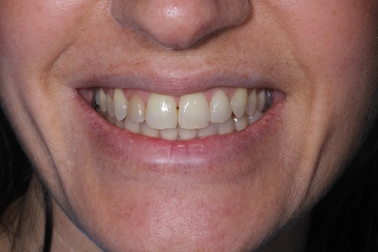 caso di bonding dentale 22 marzo prima